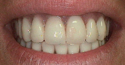 Dentures Patient